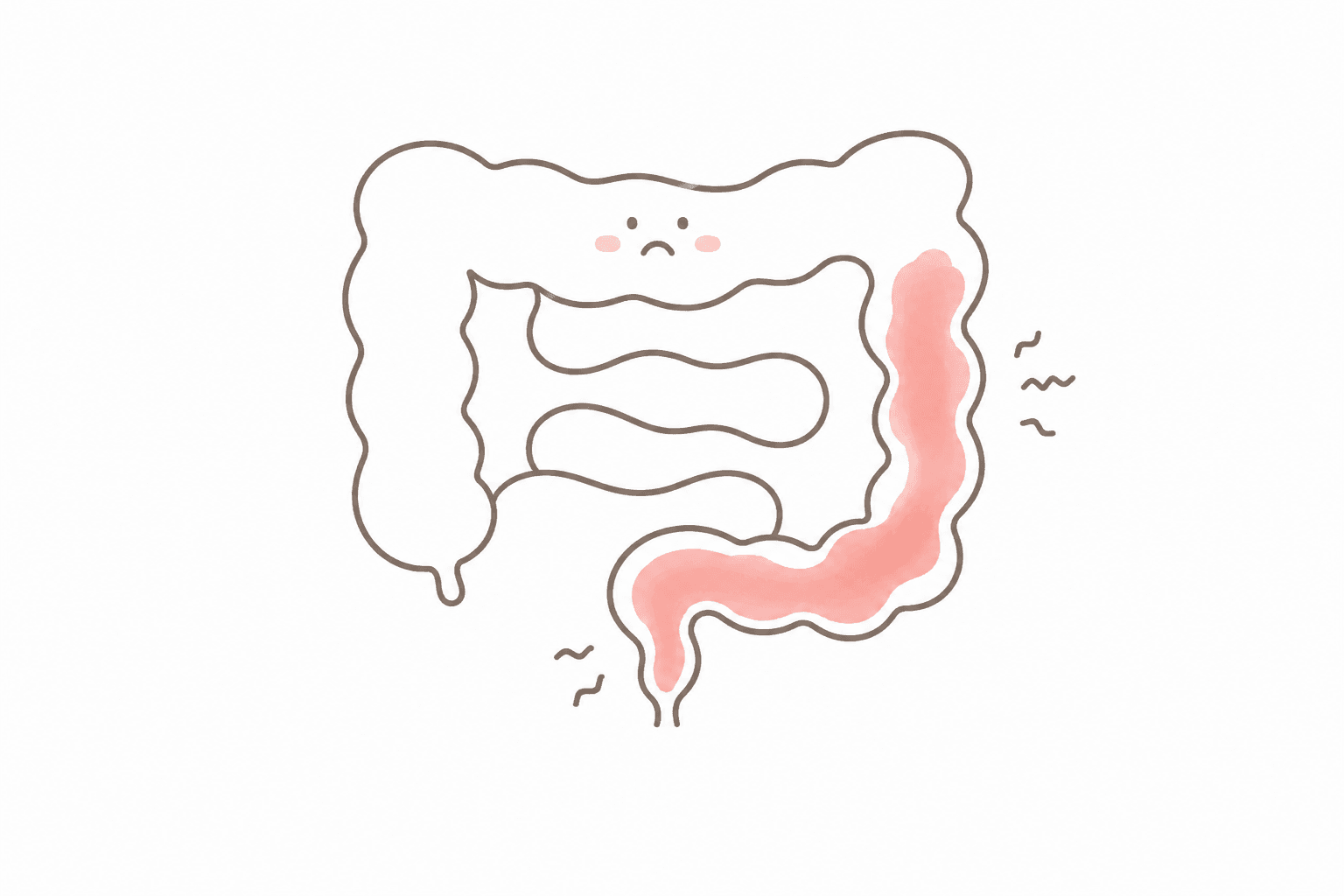 大腸の粘膜に炎症が生じている様子を示す医療イラスト